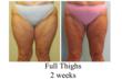 thigh liposuction, tumescent liposuction, lipo, affordable liposuction, liposuction contest, free liposuction